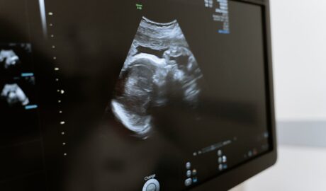 miscarriage